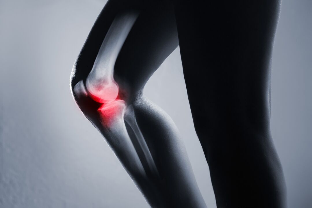 възпаление на колянната става с артроза