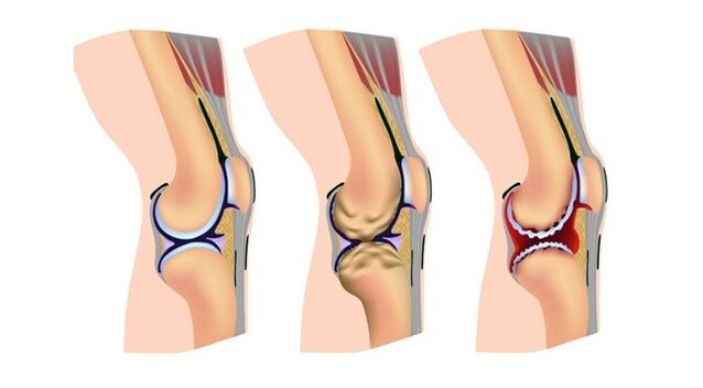 етапи на артроза на колянната става