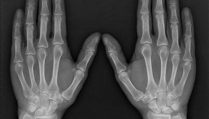 рентгенова снимка за диагностика на артрит и артроза