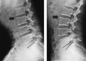 изместване на прешлените при гръдна остеохондроза