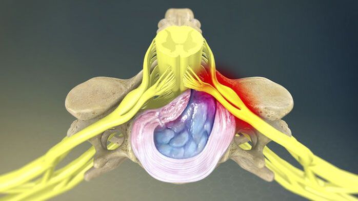 Една от причините за болки в гърба е дисковата херния. 