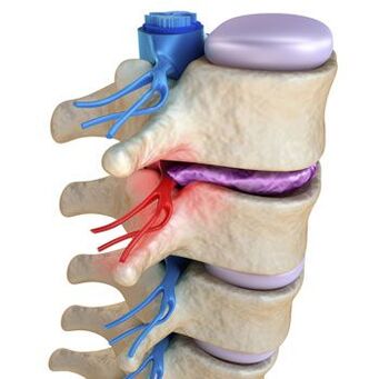 Прищипаният нерв в гръбначния стълб е придружен от стрелкаща болка